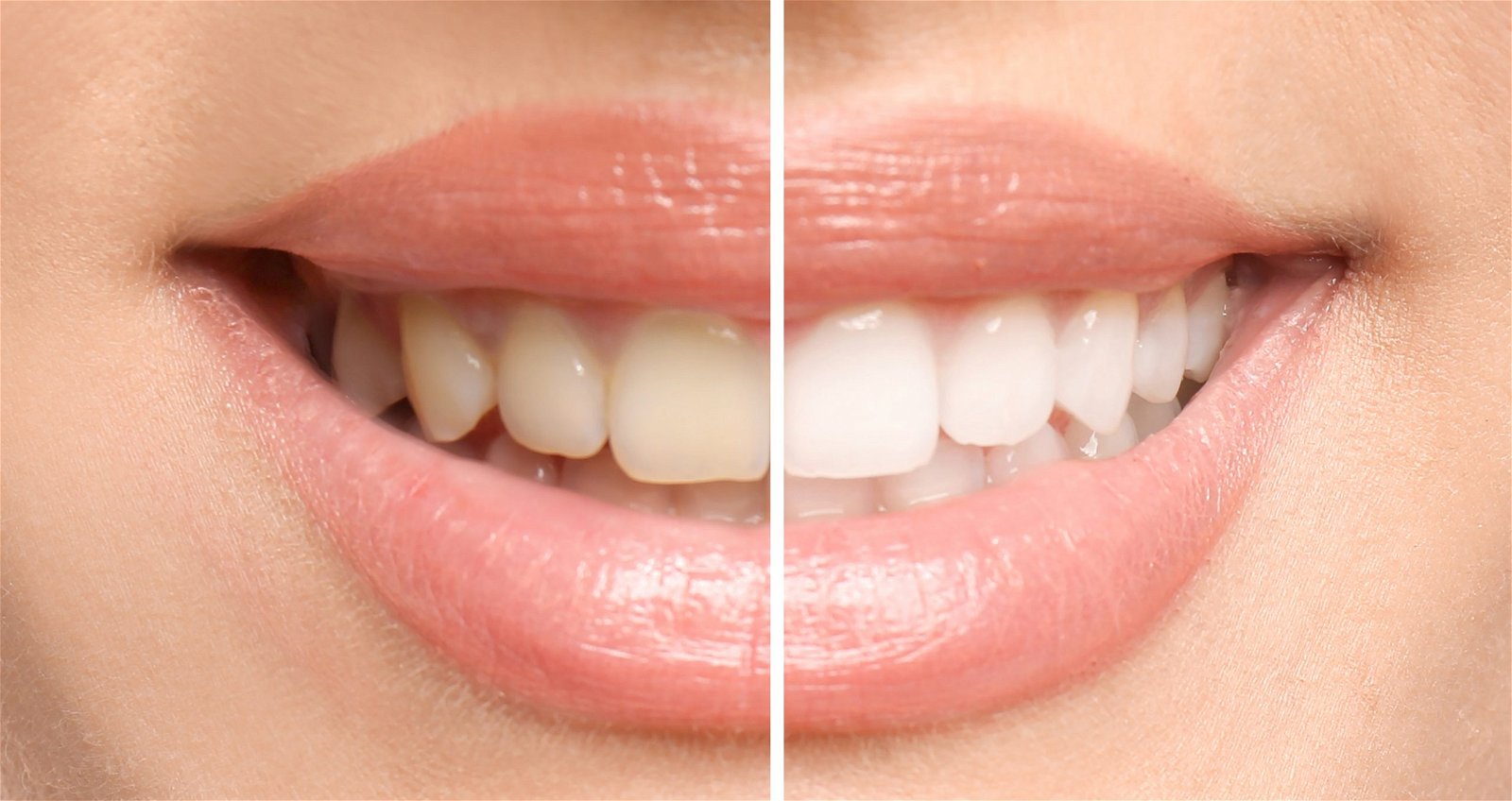 Teeth Whitening | Prescott Valley, AZ - Wilson Aesthetics